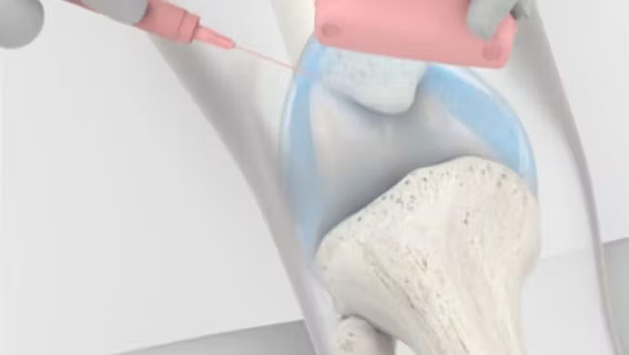 DİZ OSTEOARTRİTİ TEDAVİSİNDE YENİ HİDROJEL ENJEKSİYONU, HASTALARA AMELİYAT OLMADAN HAREKETLİLİK İMKANI SUNUYOR